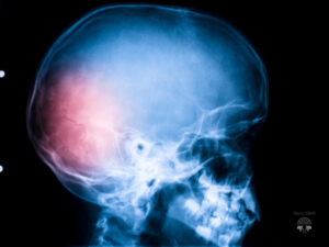 cannabis e traumas psicológicos